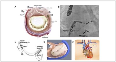 Indirect Annuloplasty to Treat Functional Mitral Regurgitation: Current Results and Future Perspectives